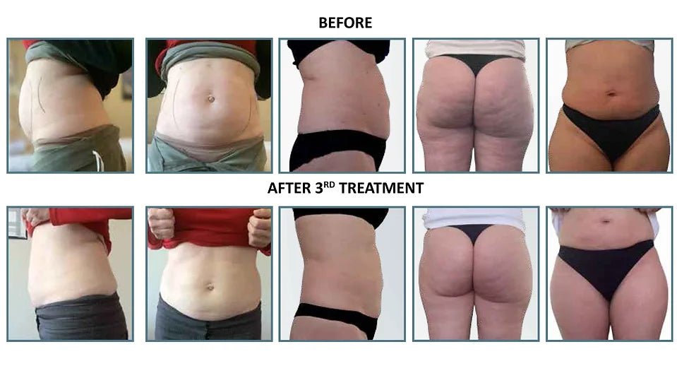 Achieving a Slimmer Figure with Lipo Slimming Injections
