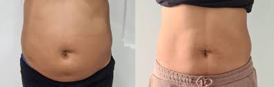 Get Your Dream Body with These Safe and Effective Fat Dissolver Injections