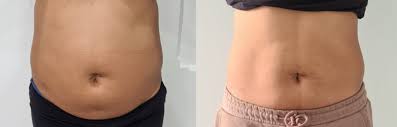 Get Your Dream Body with These Safe and Effective Fat Dissolver Injections - Foxy Beauty