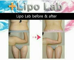 Say Goodbye to Flabby Arms with Lipo Lab Injection