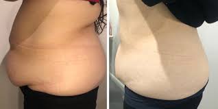 Say Goodbye to Stubborn Fat with Fat Dissolving Injections - Foxy Beauty