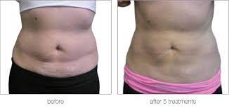 The Benefits of Fat Dissolving Injections
