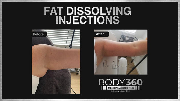 Top Clinics for Fat Dissolving Injections in South Africa - Foxy Beauty