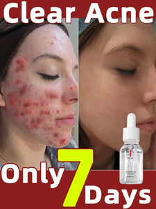 Acne Treatment Serum Korean Skincare Essence - Foxy Beauty