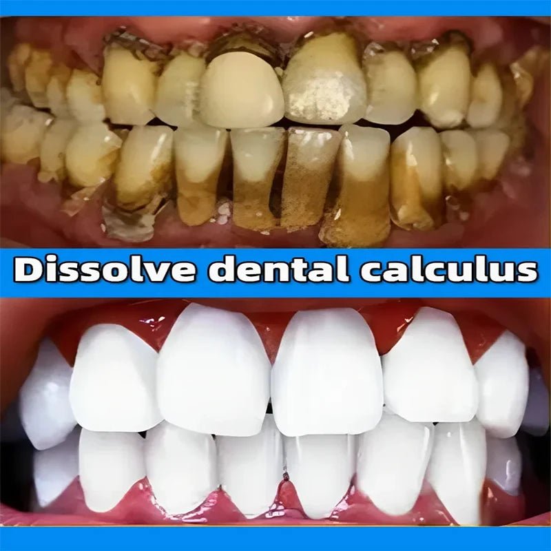 Dental Calculus Remover and Whitening Toothpaste