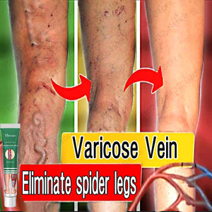 Effective Varicose Vein Treatment Cream