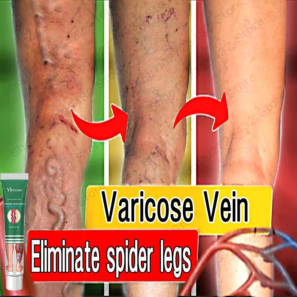 Effective Varicose Vein Treatment Cream