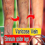 Effective Varicose Vein Treatment Cream