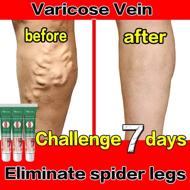 Effective Varicose Vein Treatment Cream