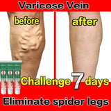 Effective Varicose Vein Treatment Cream