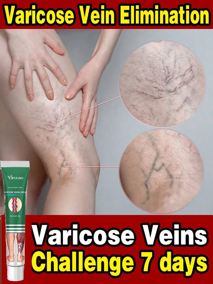 Effective Varicose Vein Treatment Cream