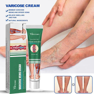 Effective Varicose Vein Treatment Cream