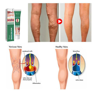 Effective Varicose Vein Treatment Cream