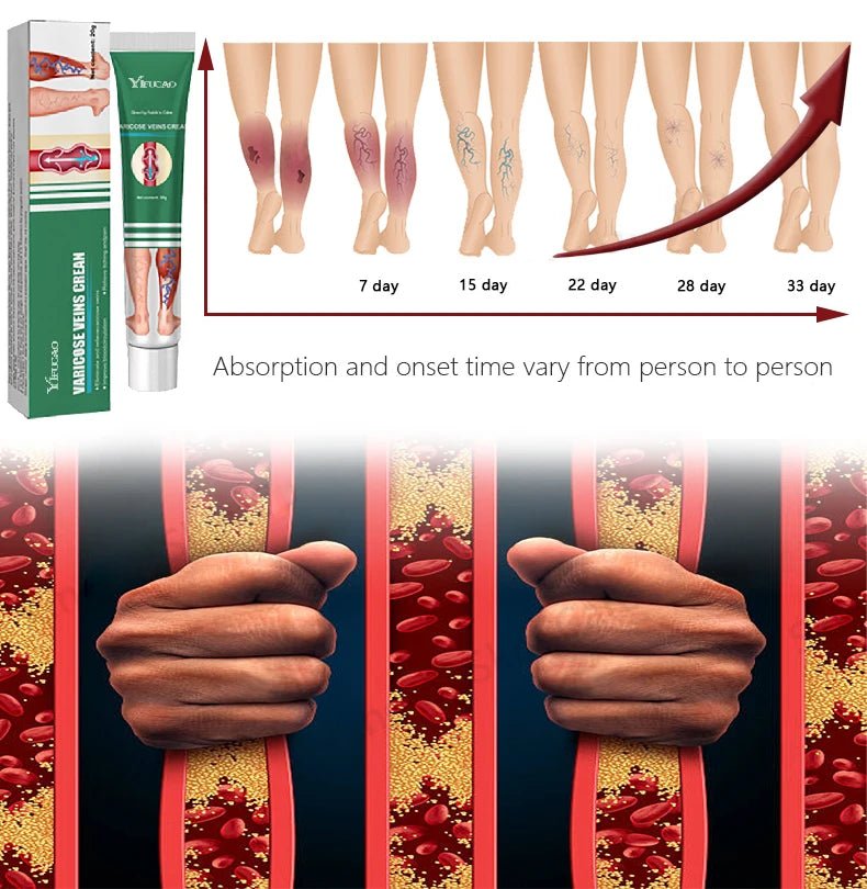 Effective Varicose Vein Treatment Cream