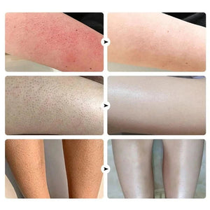 Keratosis Pilaris Repair Cream Moisturizer