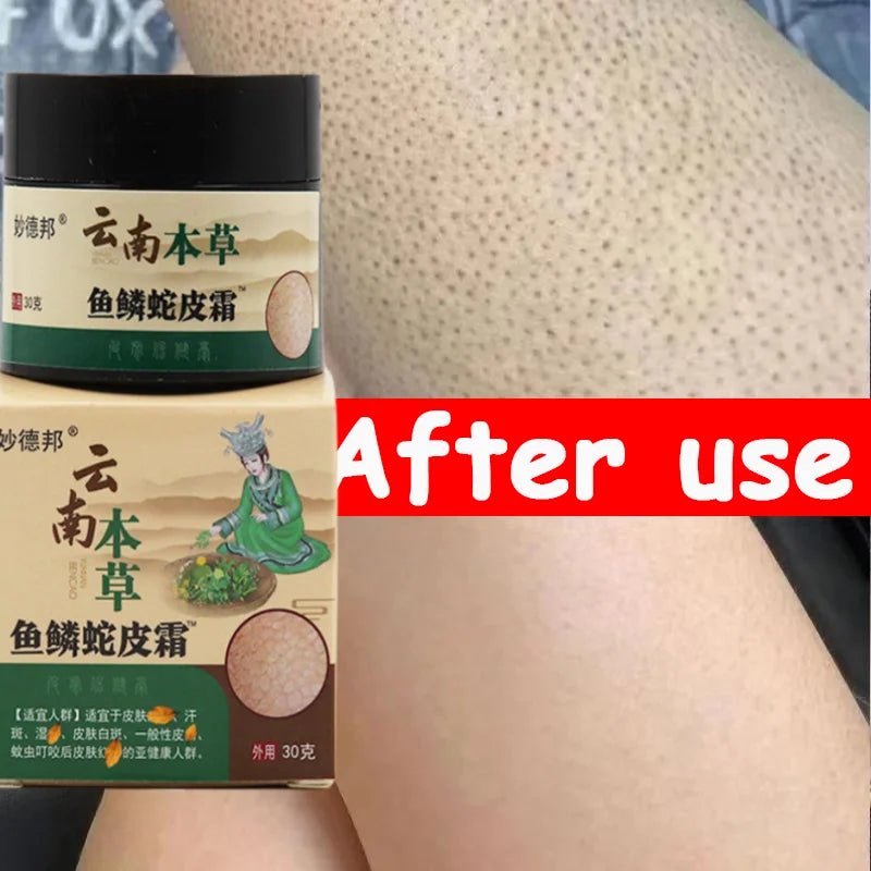 Keratosis Pilaris Repair Cream Moisturizer