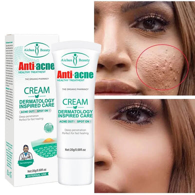 Salicylic Acid Acne Cream Scar Treatment