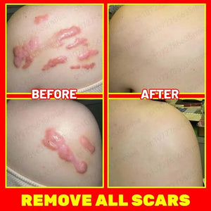 Scar Removal Cream - Acne Scar removal cream