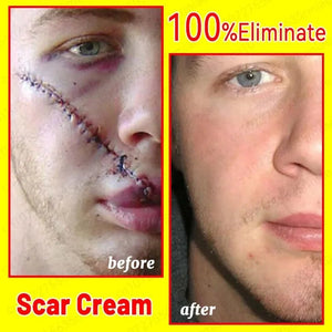 Scar Removal Cream - Acne Scar removal cream