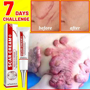 Scar Removal Cream - Acne Scar removal cream