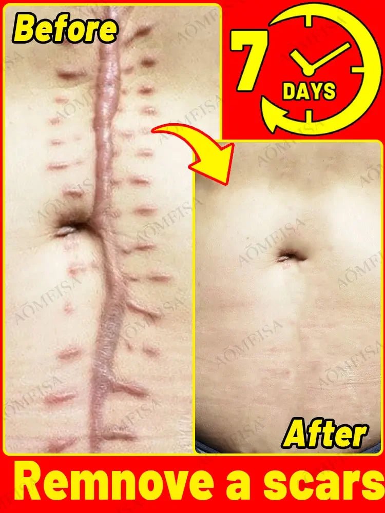 Scar Removal Cream - Acne Scar removal cream