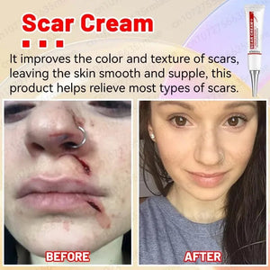 Scar Removal Cream - Acne Scar removal cream