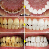 Teeth Whitening Serum South Africa